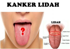 INI GEJALA KANKER LIDAH